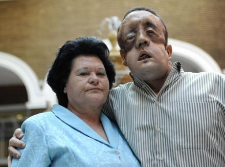 Primele fotografii cu bărbatul care a suferit un transplant de faţă (FOTO) 